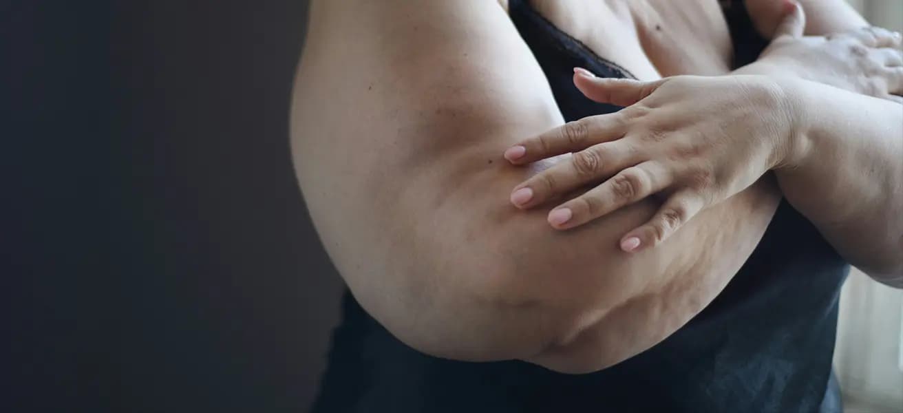 Behandlung bei Lipödem: Möglichkeiten zur Linderung der Beschwerden