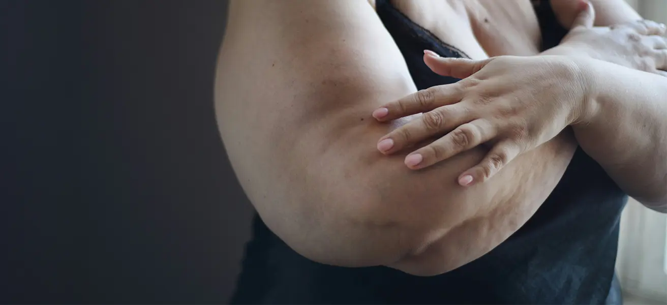 Behandlung bei Lipödem: Möglichkeiten zur Linderung der Beschwerden